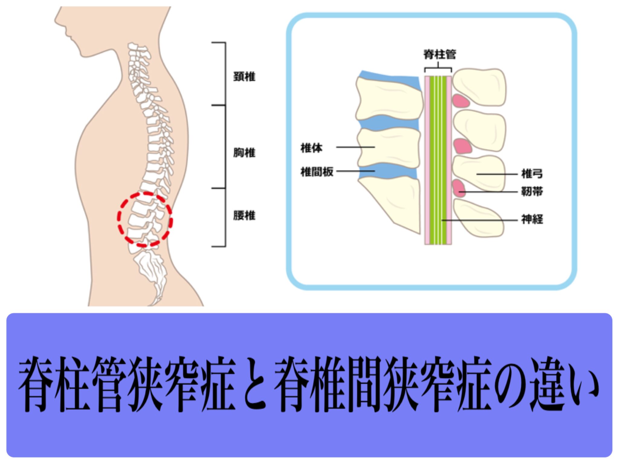 脊柱管狭窄症と脊椎間狭窄症の違いについて｜名古屋市緑区の整体で腰痛改善なら赤月堂