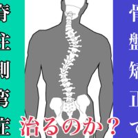 骨盤矯正で脊柱側弯症は治るのか？