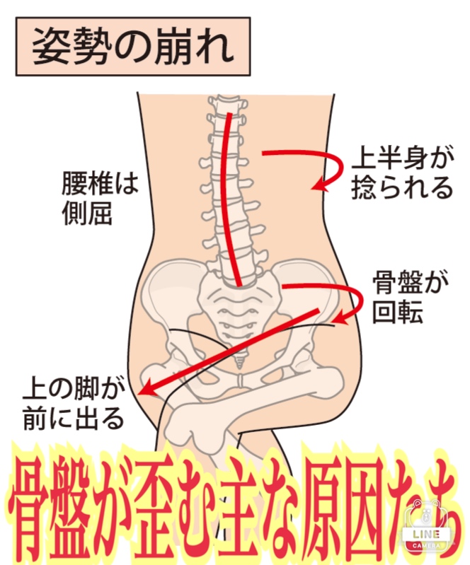 骨盤が歪む主な原因