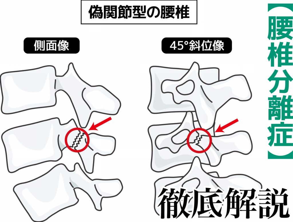 脊椎分離症・腰椎分離症：症状、原因、治療法、予防法をわかりやすく解説