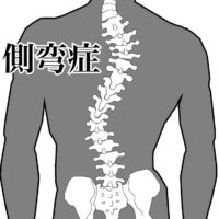 脊柱側弯症
